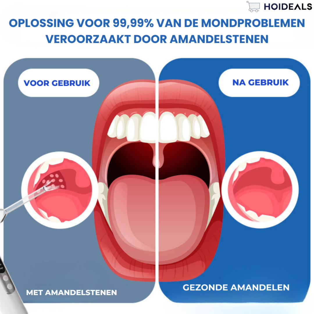 Verwijdering van tandsteen bij orthodontie | 70% Korting